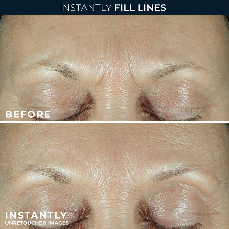 ROC Derm Correxion Serum Fill + Treat for Face, Neck, & Jawline Wrinkle Filler Advanced Retinol & Triple Hyaluronic Acid 15ml